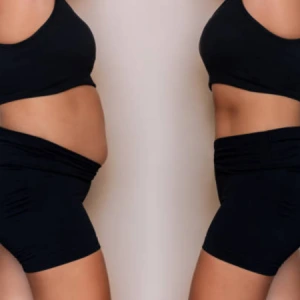 Liposuction Before and After