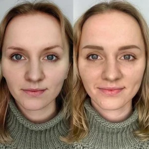 Before and After Hydrafacial