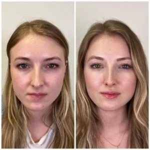 Hydrafacial Before After