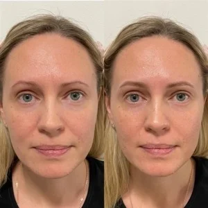 Hydrafacial Before and After