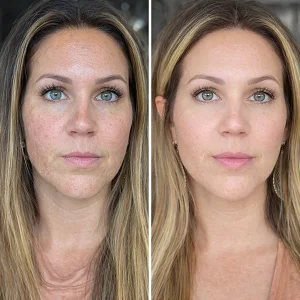 Inno Peel Before and After
