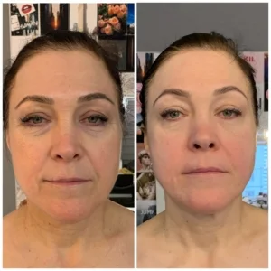 Hifu Treatment Before and after