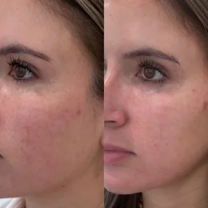 Laser Carbon Peel Before and After
