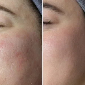 Laser Carbon Peel Before and After