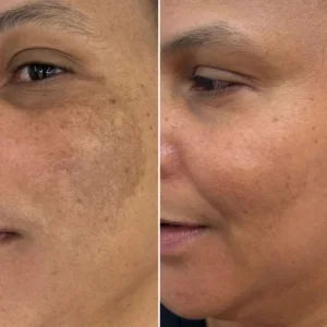 Laser Carbon Peel Before and After