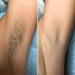 Laser Hair Removal before and after