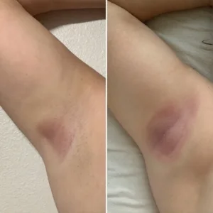 Laser Hair Removal before and after