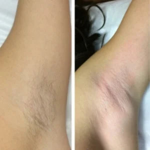 Laser Hair Removal before and after