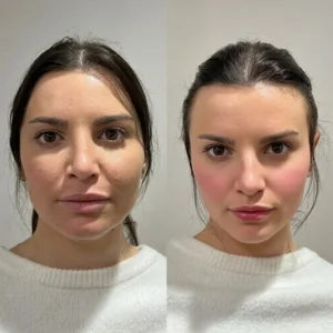 Cosmetic injectables before and after