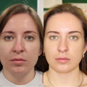 Cosmetic injectables before and after