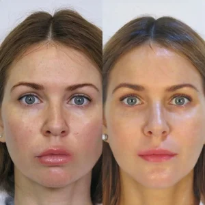 Cosmetic injectables before and after