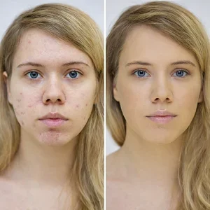 Laser Hair Removal in Shakhbout City