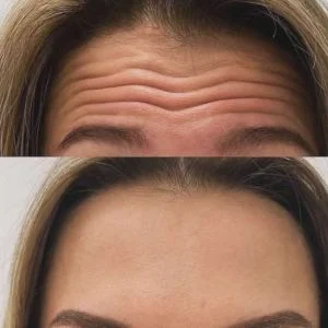 Forehead Lift Before and After