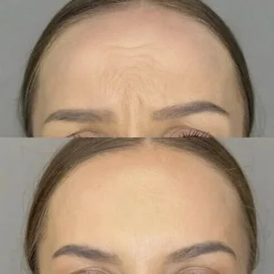 Forehead Lift Before and After