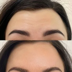 Forehead Lift Before and After