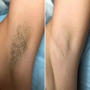 Laser Hair Removal in Shakhbout City